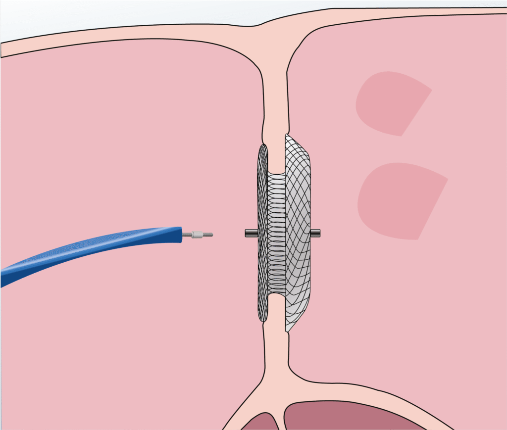 Structural heart procedure - Balloon Valvuloplasty