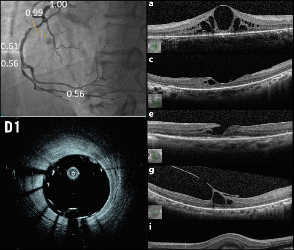 Angioplasty procedure - Coronary stent placement