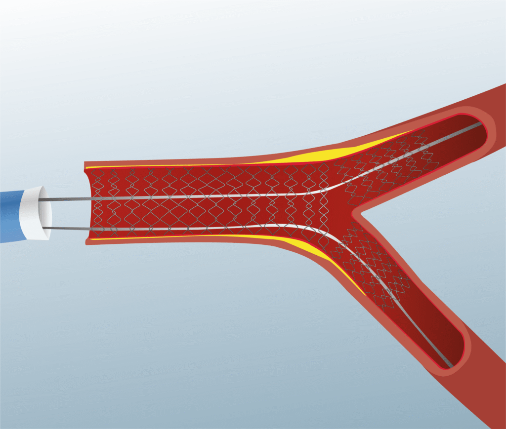Angioplasty procedure - Balloon angioplasty