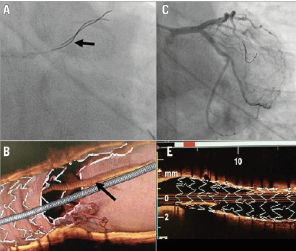 Angioplasty procedure - Complex coronary intervention