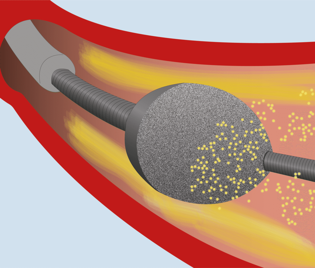 Angioplasty procedure - Bifurcation stenting