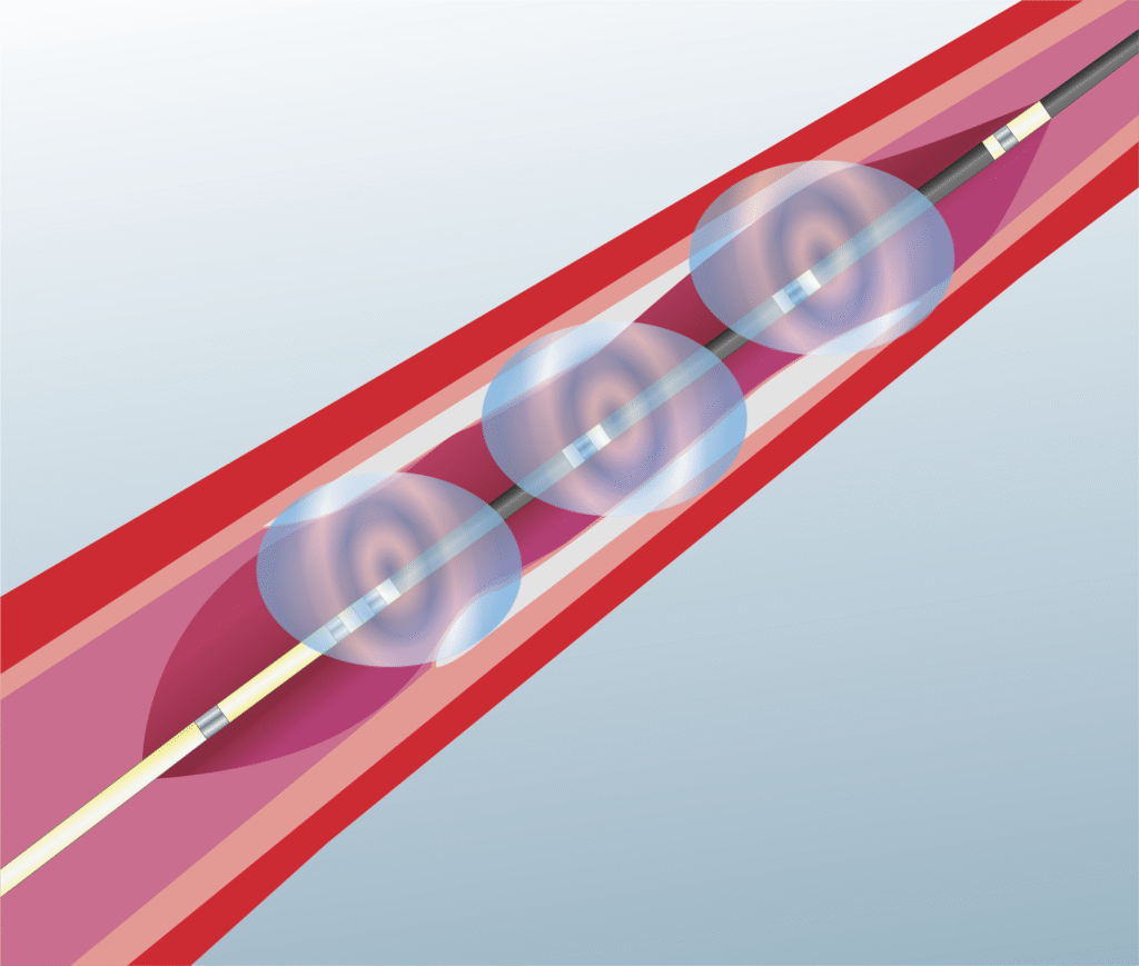 Angioplasty procedure - Left main intervention
