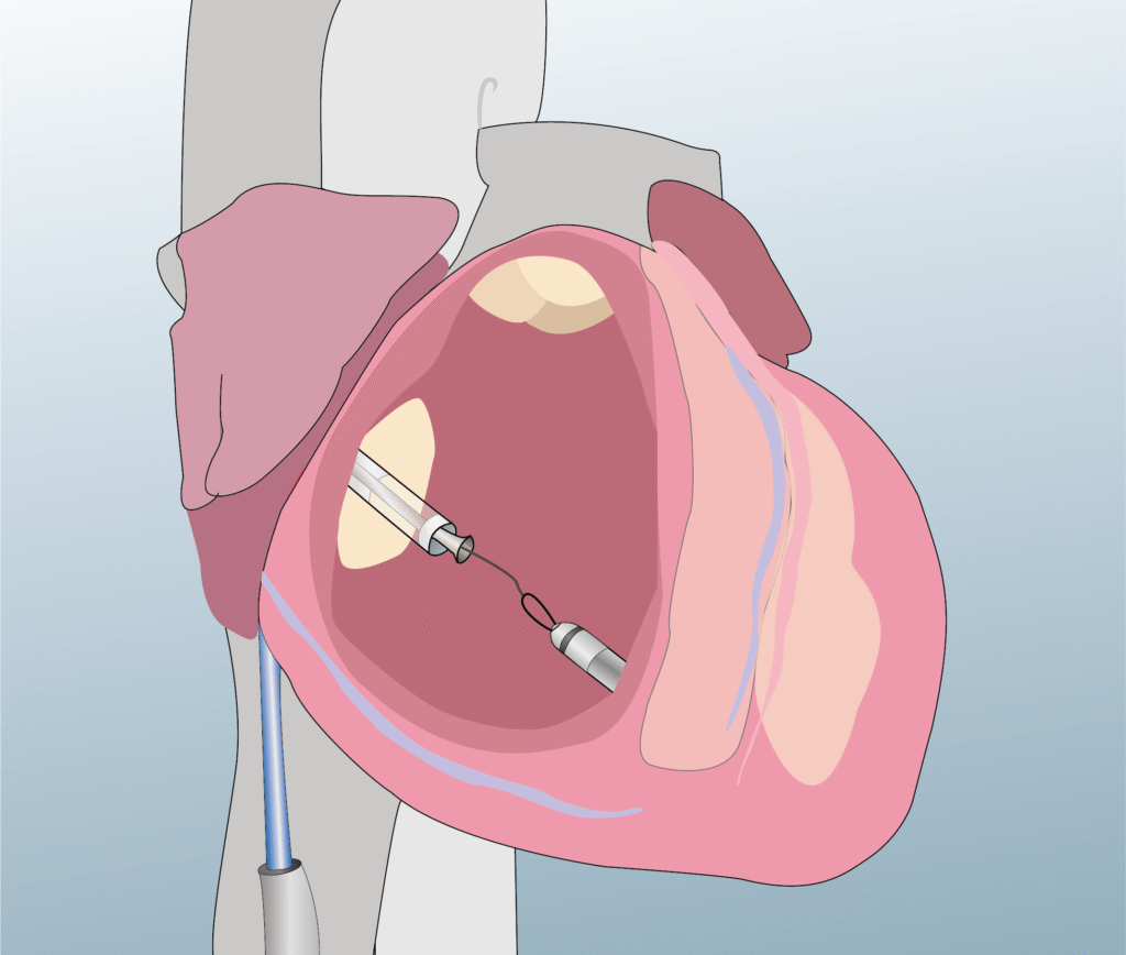 Pacemaker implantation - CRT device