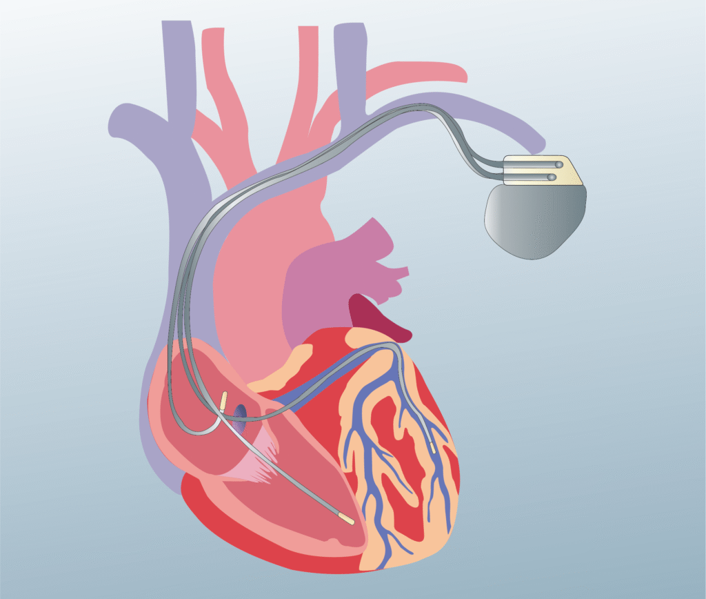 Pacemaker implantation - Permanent pacemaker