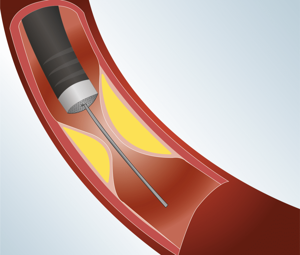 Angioplasty procedure - Chronic total occlusion