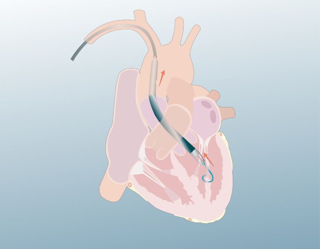 Pacemaker procedure at Ruby Hall Clinic