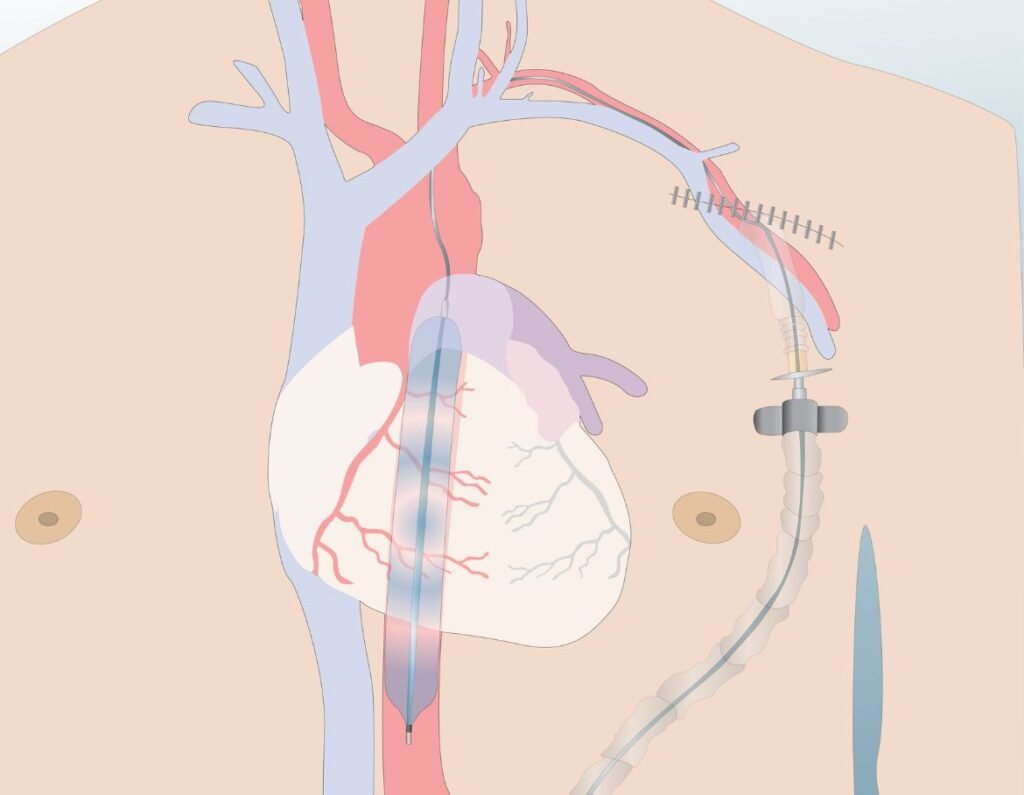 Cardiac rhythm management device
